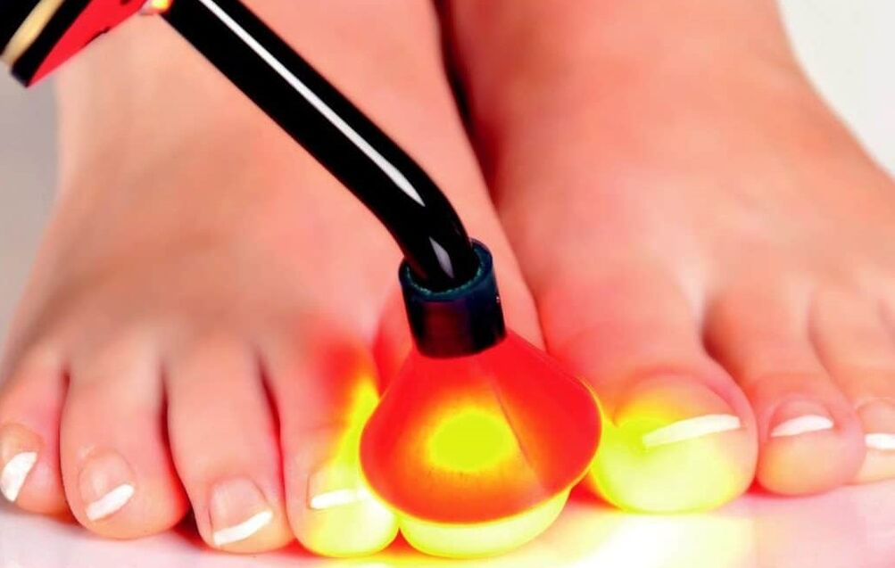 Tratamento con láser da placa de uñas
