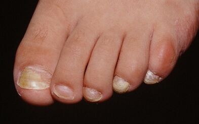 Os motivos da aparición do cogomelo no dedo pulgar da perna