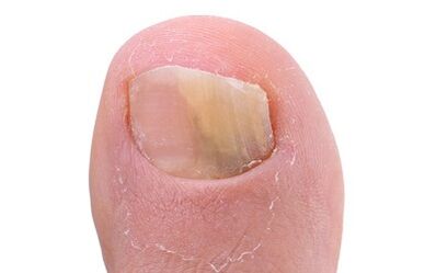 Síntomas da presenza de cogomelos no dedo pulgar da perna