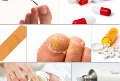 Como tratar os cogomelos nas uñas