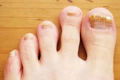 Fungo das uñas