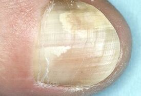 Danos na placa das uñas causadas por unha infección fúngica